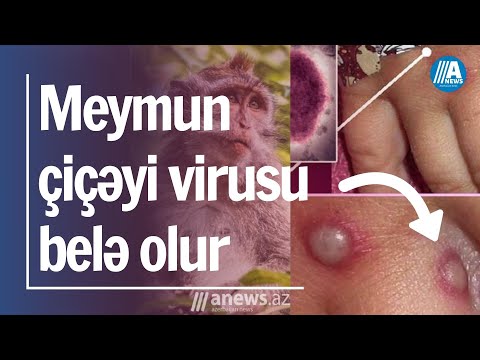 Video: Çiçək xəstəliyi necə yayılır?