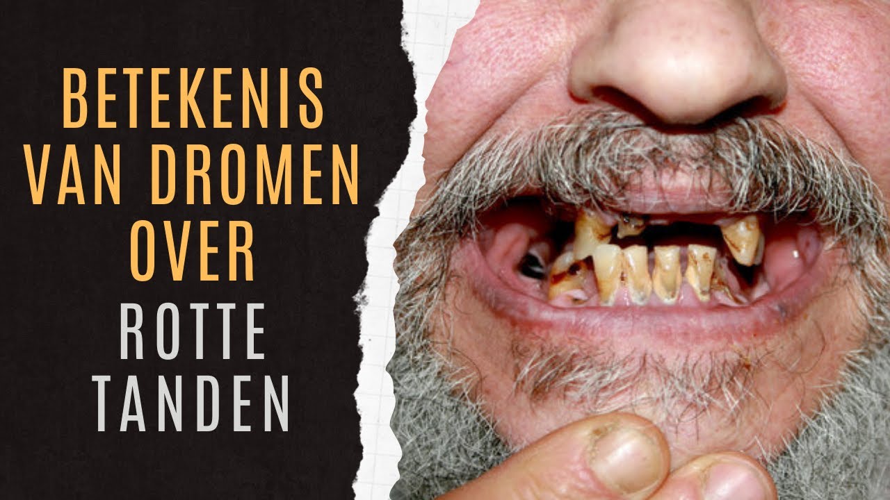 Tynd Rotte Rotte Tanden Droomanalyse | Rotte Tanden Dromen Uitgelegd | Rotte ...