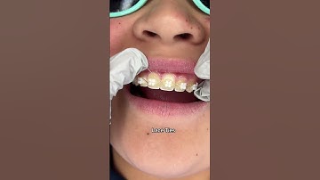 Different Types of Orthodontic Ties you can get at your Orthodontist Part 3