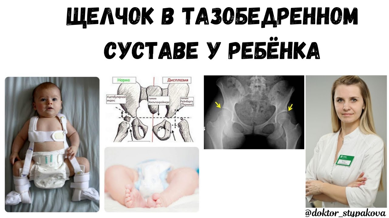 Щелчок в тазобедренном суставе при отведение ног у детей. Норма или ...