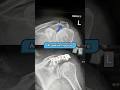 Acromion Fracture Case Study Dr Oscar Brumby Rendell Explains 