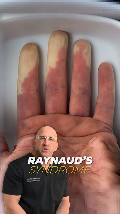 More Than Just Pale Fingers and Toes - Raynaud’s Syndrome #shorts