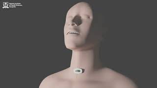 Tracheotomy - 3D Animation #Doctors #Institute #of #Health #Sciences