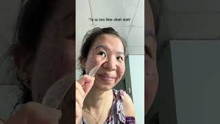 Series Đi Trị Sẹo Ở Dr.simple P2 - Cầm 27 Triệu Đi Trị Sẹo Cùng Thanh Nhé