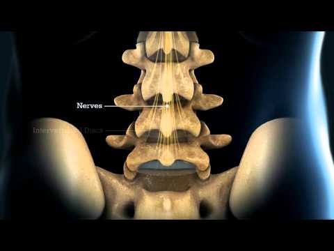 Lesi lumbar epidural steroid injection