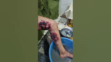 علاج عليكة الذيب 