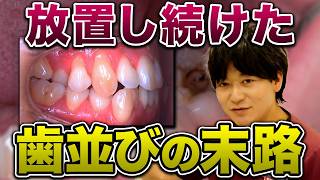 【知らないと危険】歯並びを放置した人の末路…歯周病、虫歯、歯の喪失リスクについて矯正歯科専門医が解説！
