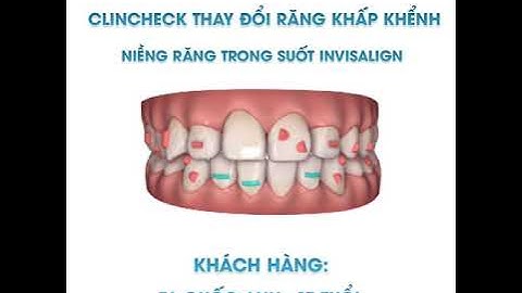 CLINCHECK NIỀNG RĂNG INVISALIGN- RĂNG CHEN CHÚC, CẮN SÂU
