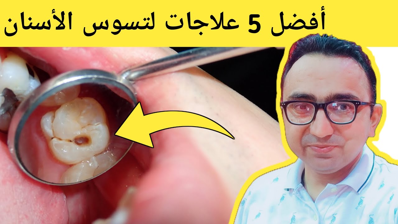أفضل 5 علاجات منزلية لتسوس الأسنان  عيادات الأسنان