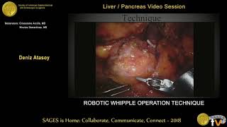 Robotic Whipple operation technique -