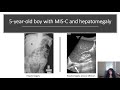 Imaging Findings in Multisystem Inflammatory Syndrome in Children (MIS-C) Associated with COVID-19