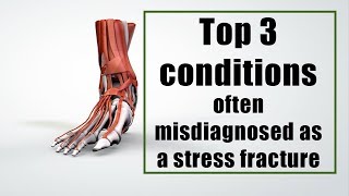 Top 3 conditions often misdiagnosed as a stress fracture in a runner
