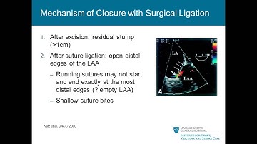 Moussa Mansour     Post Procedural LAA Exclusion Leak    Mechanisms, Implications and Treatment