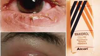 كل مايخص Maxidrol (ماكسيدرول) لعلاج التهابات العين (انتفاخ، حكة، احمرار) 👇