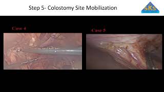 Laparoscopic Assisted Anorectoplasty (LAARP) with Laparoscopic Partial Distal Colostomy Mobilization