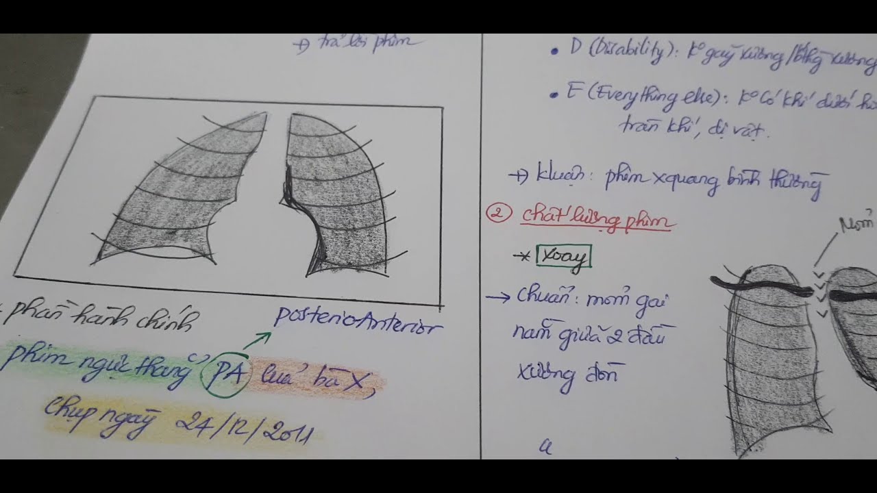 X-quang 1 - Tổng quan cách đọc phim x-quang ngực thẳng