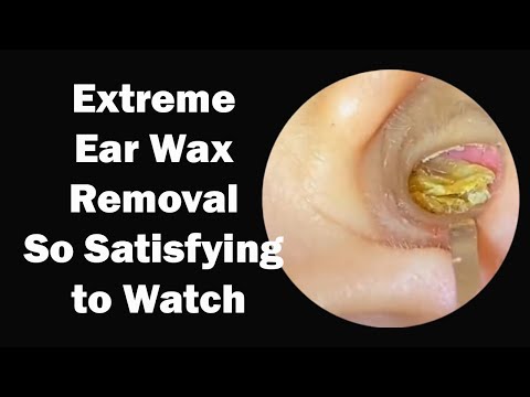 Extreme Ear Wax Removal – So Satisfying to Watch!