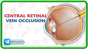 Central Retinal Vein Occlusion (Animation)