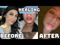 I GOT LIP FILLERS! (VLOG + MY EXPERIENCE) // LIFEBEINGDEST