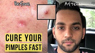 How To Get Rid of a Pimple Overnight | How to Remove Pimples Overnight | Fast Pimple Treatments