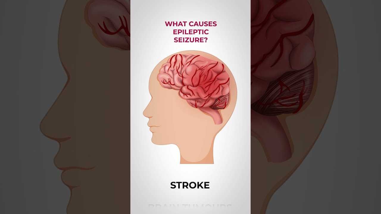 What Causes Epileptic Seizures 