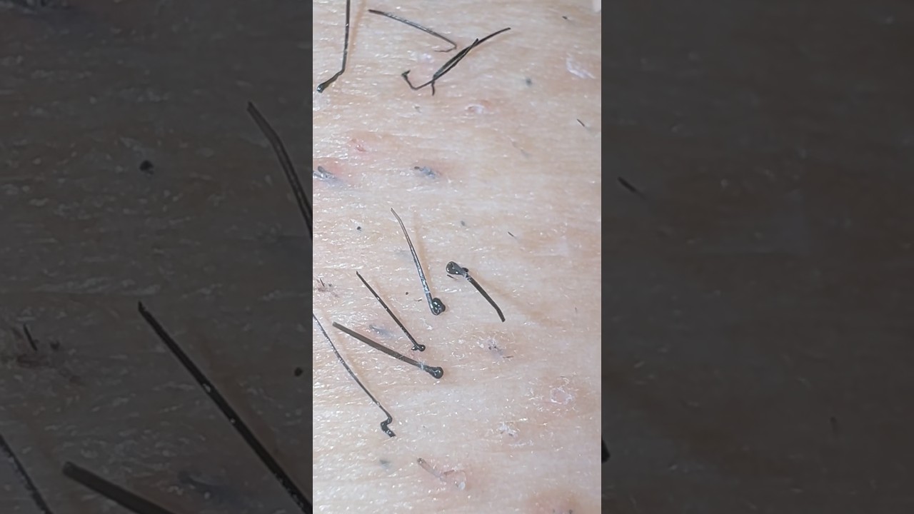 レス解消！♡ #hairremoval #satisfying #毛抜き #埋没毛 #blackheads #pimple #髭抜き