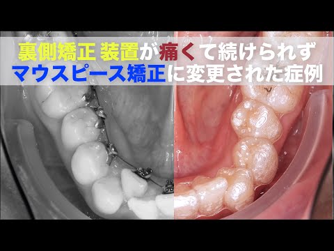 インビザライン矯正装置に変更して歯並びが綺麗になりました】裏側矯正