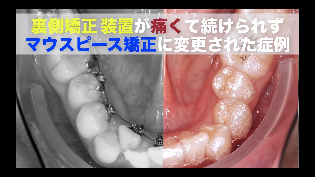 インビザライン矯正装置に変更して歯並びが綺麗になりました】裏側矯正