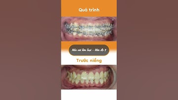 Hành trình LỘT XÁC nhờ niềng răng của Quỳnh Như