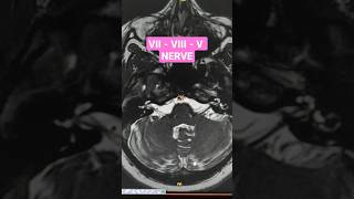 VII - VIII - V cranial Nerves viral shorts  youtubeshorts