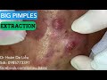 Nặn mụn nhọt khủng vùng má siêu to nhiều mủ|Squeeze super big big pimples on the cheek 0985773391