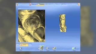 CEREC 4.0: Dr. Armen Mirzayen's beta demo