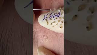 #TextBlackheads Removal  #Text Relax | satisfying   With Din Spa 2025 🛎 🐕 😻