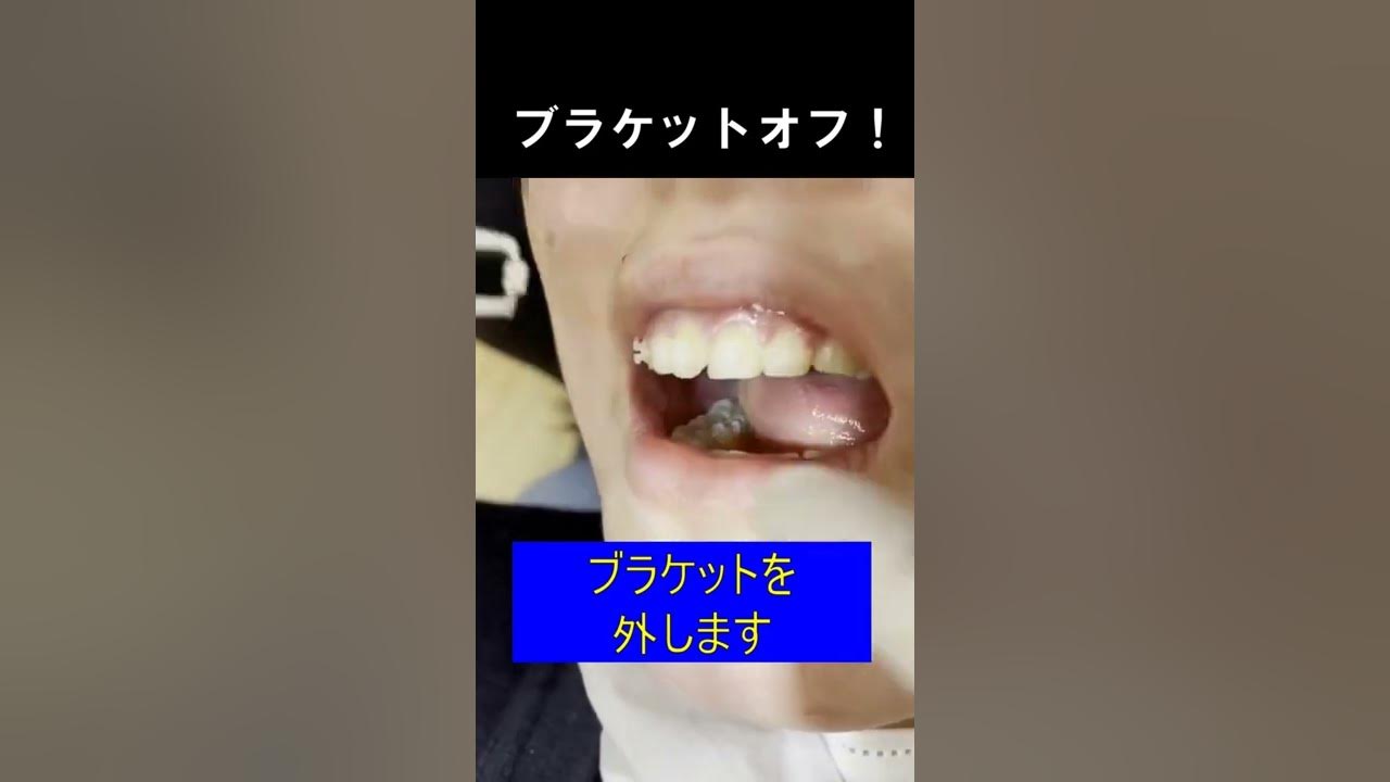 ブラケットオフ・ブラオフ Bracket removal │歯列矯正│shorts YouTube
