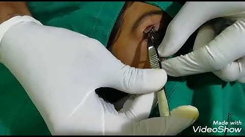 Chalazion exicison # eye surgery # Eye lid surgery