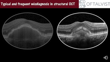 What’s "new" on OCT imaging? [ENG]