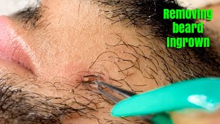 The pain of ingrown beard hair  Lasermed Laser Clinic  facial  rejuvenation