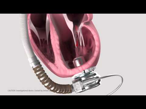 heartware ventricular assist system animated demonstration youtube