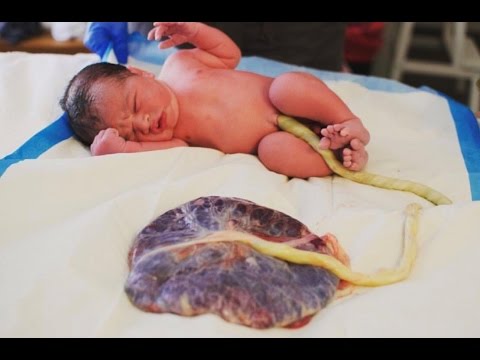 Video: Waar hecht de placenta zich aan?