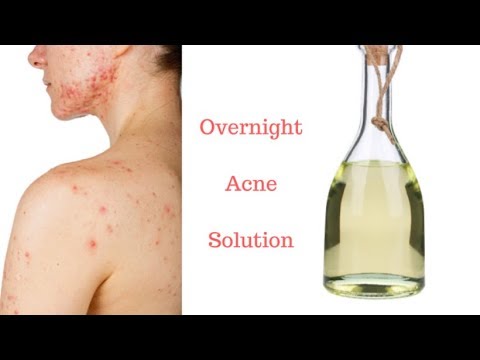 How to Clear Face and Body Acne with White Vinegar – Overnight Acne Solution