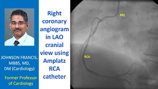 Right coronary angiogram in LAO cranial view using Amplatz RCA catheter