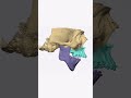 Major airway and jaw improvement using custom Orthognathic surgery