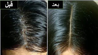 علاج قشره الشعر نهائيا من اول استخدام بمكونين فقط