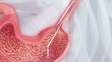 Animation of Endoflip™ Use in the Operating Room