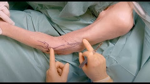 Elbow spanning external fixation preview