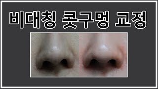 비공내리기+콧날개올리기로 비대칭콧구멍 교정하기(Re-operation rhinoplasty/before and after/nostril show)