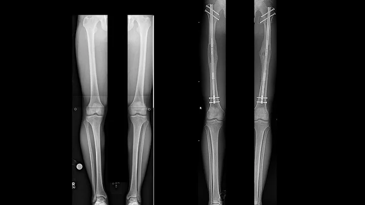 Dr. S. Robert Rozbruch - A STATURE LENGTHENING Pro...