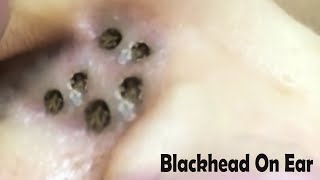 BLACKHEADの削除の満足。/ SATISFYING BLACKHEAD REMOVAL.