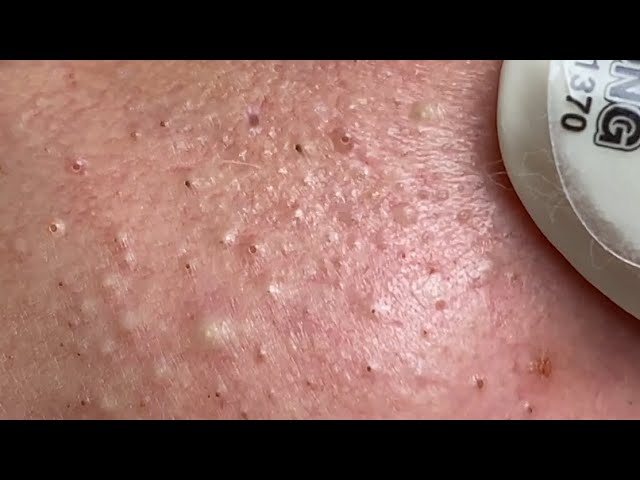 Acne Treatment Huong Da Nang#545  | 2023