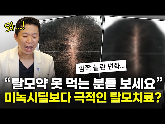 탈모약 먹지않고 정수리탈모 치료하는 방법